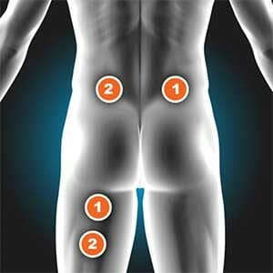 Sciatica 2
