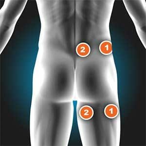 Sciatica 1